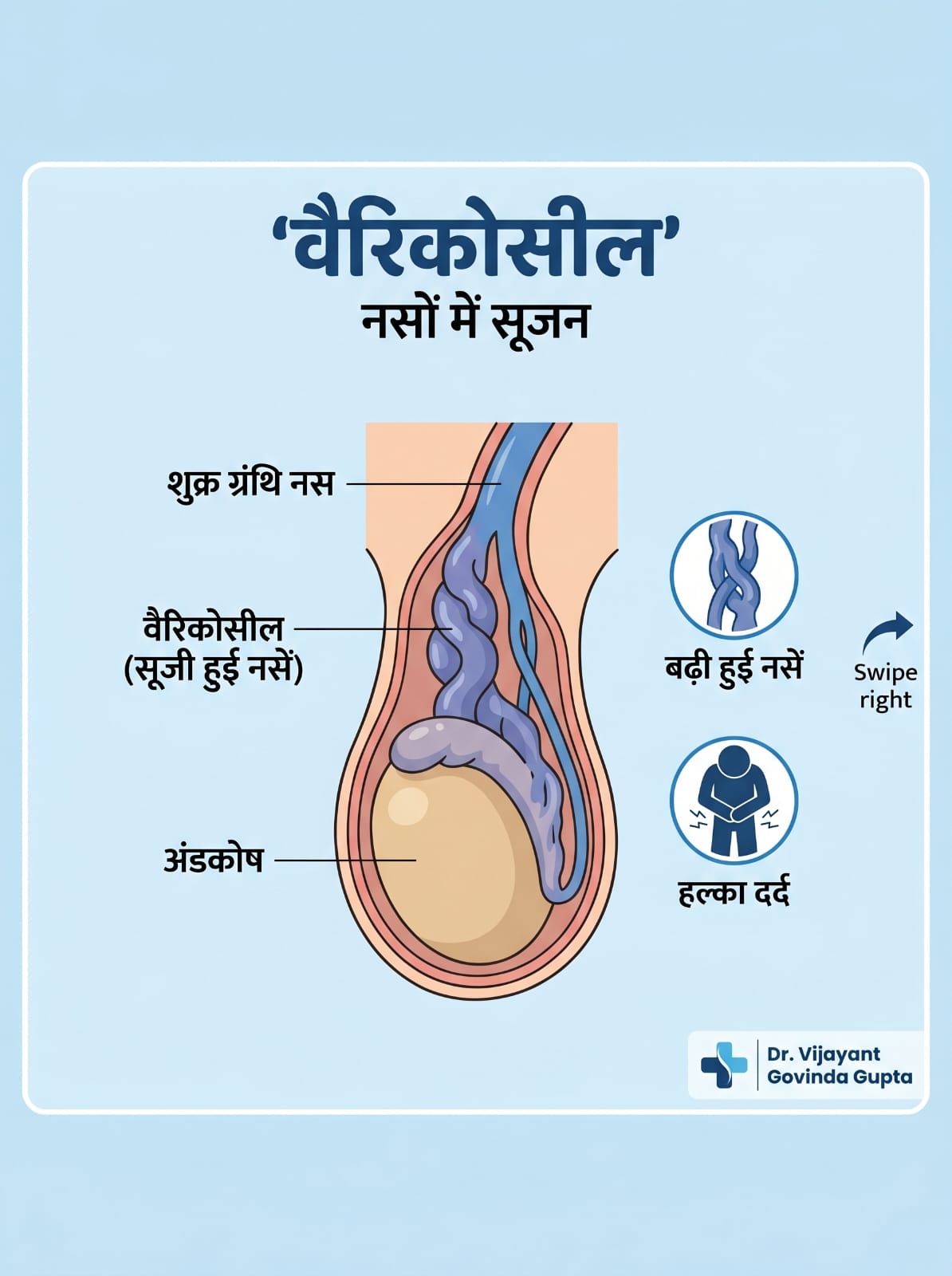 Varicocele graphic
