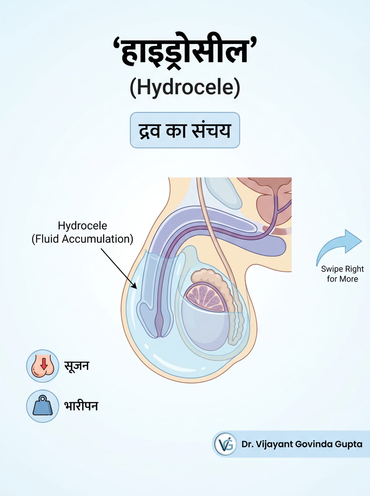 Hydrocele 